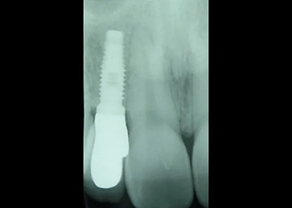 A digital radiograph from the practice's gallery: a single dental implant replacing a fractured front tooth.